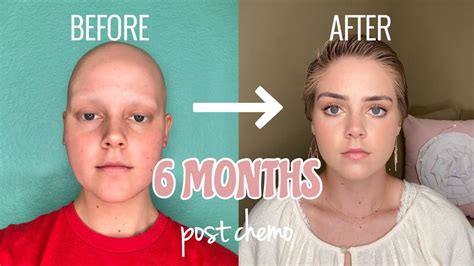 Months Post Chemo Hair Growth Youtube