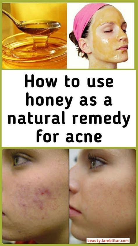 how to treat acne using honey howtomreov