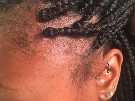 Are Braids Too Tight Here Is How To Fix This Problem Blog Unice Com