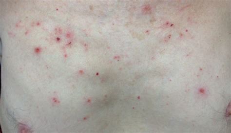 Clinical Challenge Itchy Rash On The Trunk Mpr