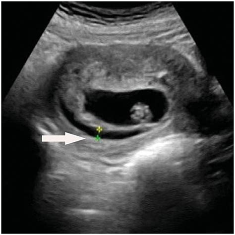 A Resolving Subchorionic Hematoma H Detected At 13 Menstrual Weeks