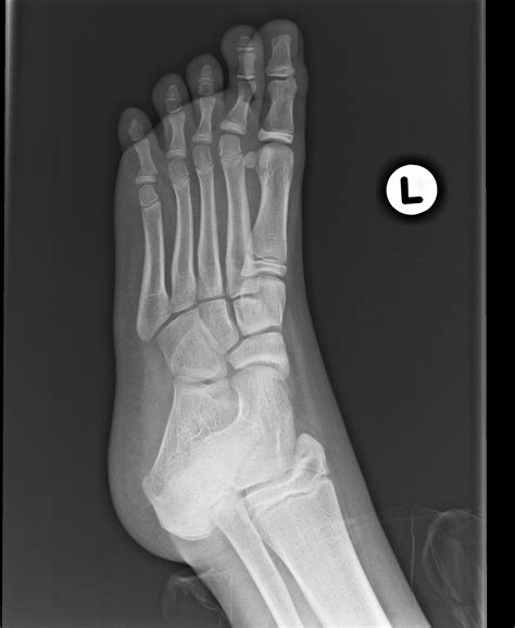 Salter-Harris type II fracture | Image | Radiopaedia.org