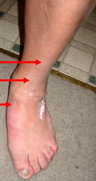 Anterior Tibial Tendonitis Foot Care Longmont Pti Orthotics Boulder My Xxx Hot Girl