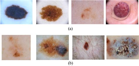 Figure From Towards Accurate Classification Of Skin Cancer From