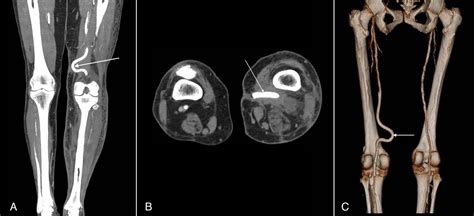 Cureus Superficial Femoral Artery Pseudoaneurysm And Arterial Wall