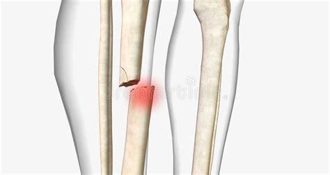 A Fracture Often Referred To As A Broken Bone Is An Acute Injury That