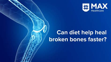 Can Diet Help Heal Broken Bones Faster