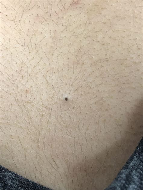 This Blackhead On The Girls Back In Front Of Me In Math Class I Want