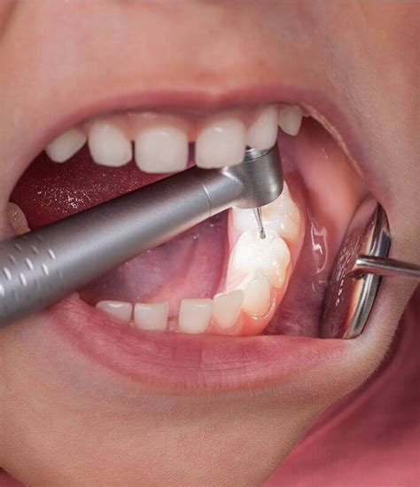 ¿quÉ Es Un Empaste Dental Clinica Dental Fabián López