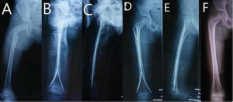 Frontiers Operative Choice For Subtrochanteric Femoral Fracture In