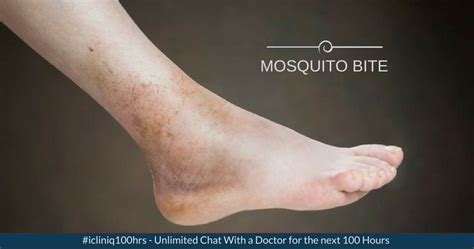 What Is The Possible Reasons For The Leg Swelling Due To Mosquito Bite