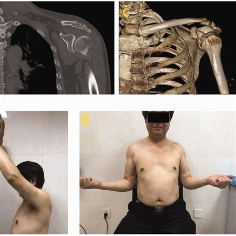 Preoperative And Postoperative X Rays Of Neer Type Iib Distal Clavicle