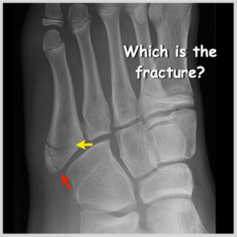 Radiology Signs • 10yo with base of 5th metatarsal pain ...