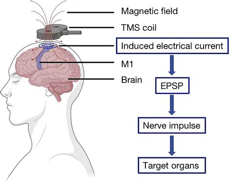 Transcranial Magnetic Stimulation For Migraines