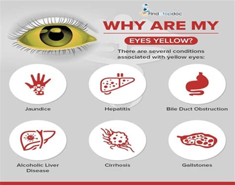 Yellow Eyes Jaundice Eyes Home Remedies And Treatment