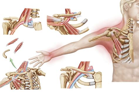 Posterazzi Medical Illustration Detailing Thoracic Outlet Syndrome