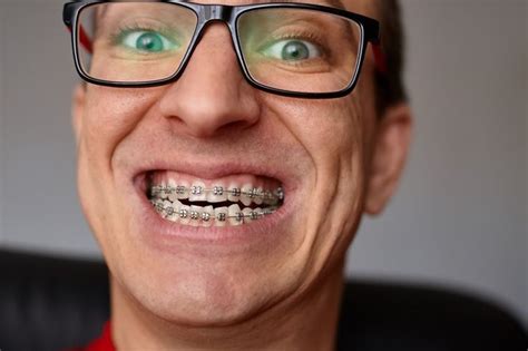 Curved Teeth Of Guy With Braces In G Featuring Braces Tooth And