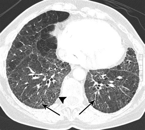Ct Findings In Diseases Associated With Pulmonary Hypertension A