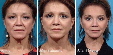 Year Facelift Cosmetic Surgery Plastic Surgeon Plastic Surgery
