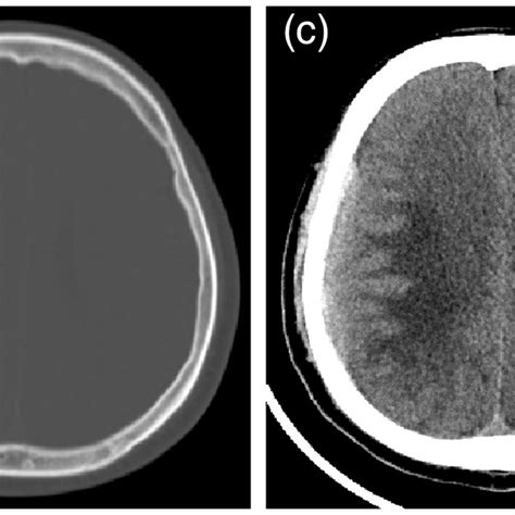 A Series Of Head Computed Tomography Scans On A B Day 1 C Day 21