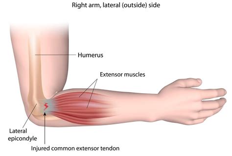 Muscles acting on the proximal and distal radioulnar joints, biceps tendon rupture and how to differentiate it from rupture of the long head of biceps, injury of the musculocutaneous nerve in the arm, dorsal radial picture tests in anatomy lower limb knee and popliteal fossa. Tennis Elbow - Lateral Epicondylitis - Raleigh Hand Surgery — Joseph J. Schreiber, MD