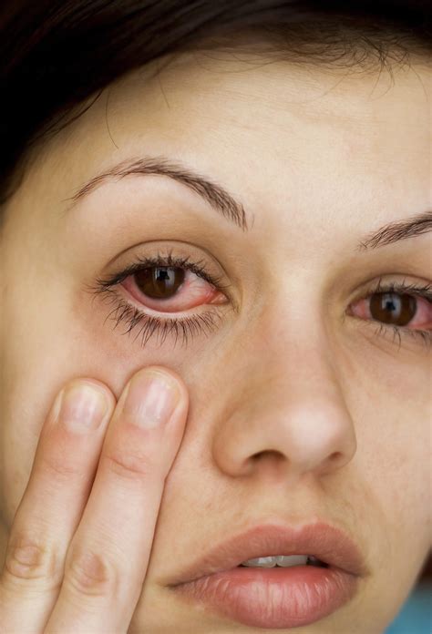 Allergies Of The Eyes Black And Kletz Allergy
