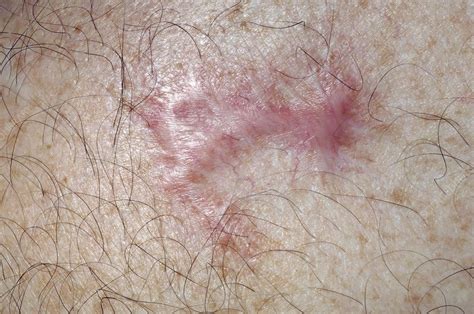 Keloid Scar After Cancer Removal Stock Image C0044271 Science