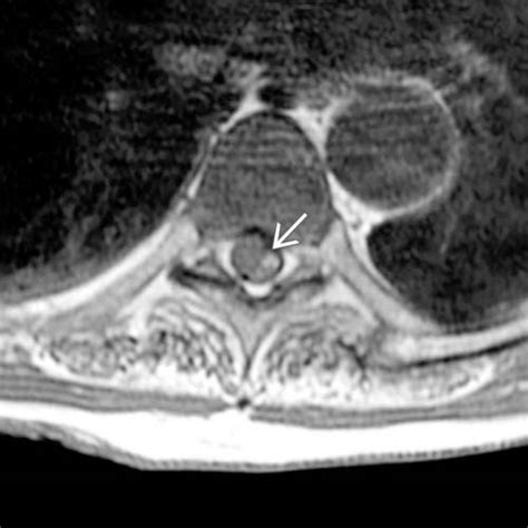 Spinal Artery Aneurysm Radiology Key