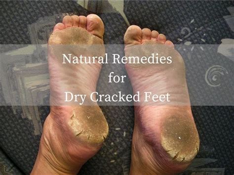 Natural Remedies For Dry Cracked Feet Pedicure Crackedheels Dry Cracked Feet Natural