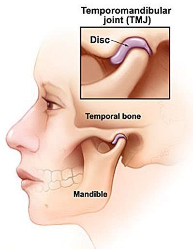 Temporomandibular Joint (TMJ) Disorder - Physiotherapy ...