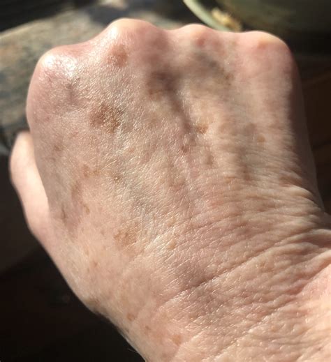 Brown Spots On Hands