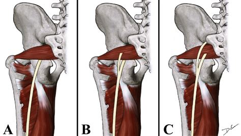 Figure 1 From Anatomical Variations Of The Sciatic Nerve Exit From The Pelvis And Its