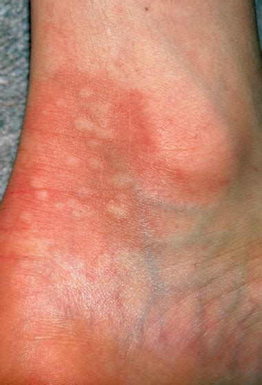 Nhs Direct Wales Encyclopaedia Skin Rashes In Children