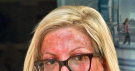 Tori Spelling Leaves A Medical Spa With A Very Blotchy Red Face After