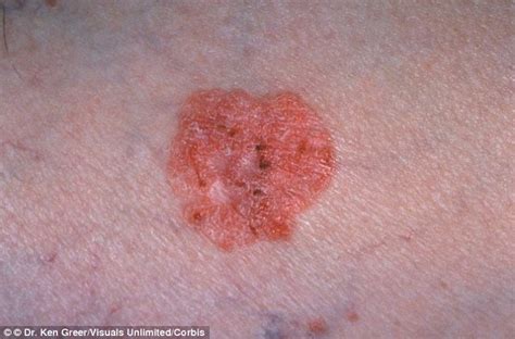 Health Bulletin Co Revealed How To Tell If You Have Skin Cancer