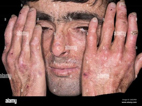 Hands And Face Of A Male Patient With Porphyria Cutanea Tarda Pct A