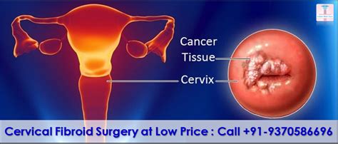 The indian health system is one of the largest in the world, with the number of people it concerns: Cervical Fibroid Surgery in India at Low Price : Special Packages for Malawi Patients by Ankita ...