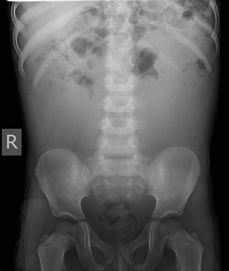An Unusual Case Of Abdominal Distension With Constipation Adc