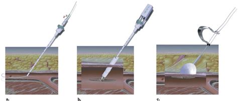 Percutaneous Arterial Closure Devices Journal Of Vascular And