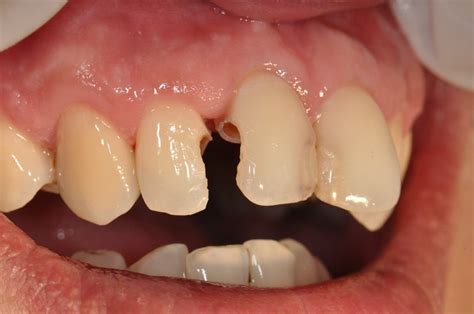 Cases Of Restoration With Composite Resin Prestige Dental Care