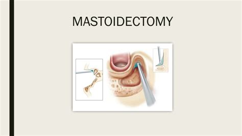 Ppt Mastoidectomy Meddco Powerpoint Presentation Free Download Id