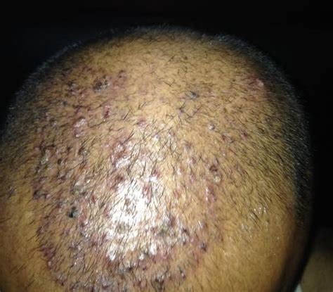 Scalp Infections Pictures Pictures Photos