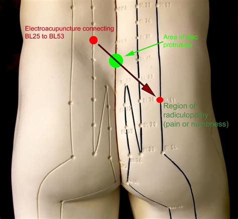 Acupressure points for sciatica pain. Low Back Pain Acupuncture CEU Course Sample