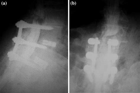 Degenerative Lumbar Instability Stabilization Radiology Key