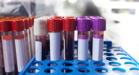 This test measures the amount of bile pigment in the blood. What do your lab test results mean? | UC Irvine Health ...