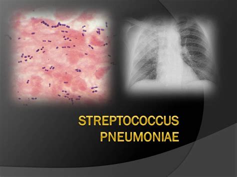 Streptococcus Pneumoniae Youtube