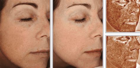 Halo Skin Treatment Before And After Your Magazine Lite