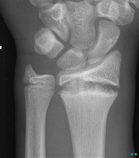 Gymnast Wrist Radiology Case Radiology Radiology
