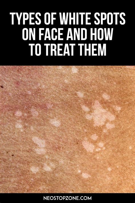 Types Of White Spots On Face And How To Treat Them Spots On Face