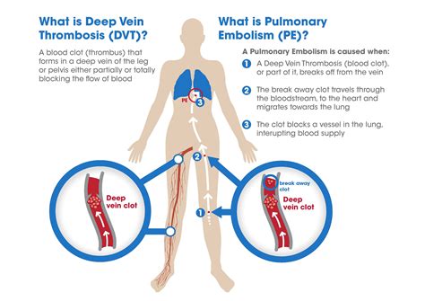 Malignant tumors trigger inflammation in surrounding normal lung tissue, and they may obstruct your airways and interfere with normal airflow. Deep Vein Thrombosis And Pulmonary Embolism a Guide For ...